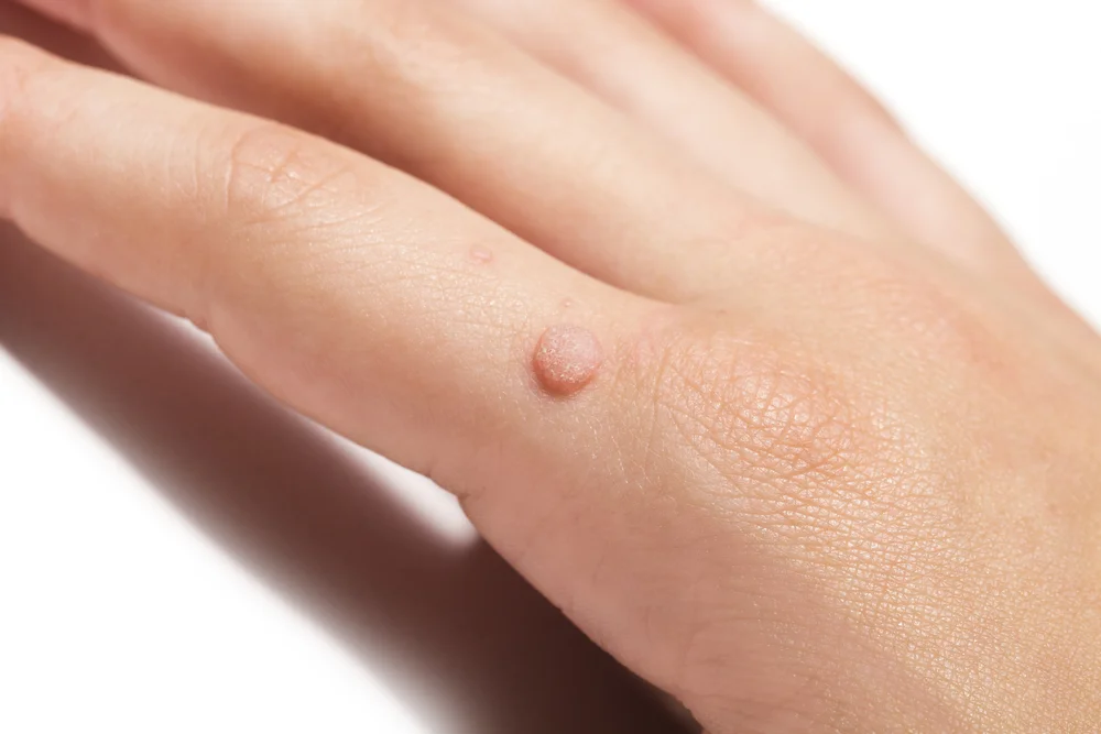 wart removal london