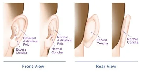 ear anatomy for otoplasty surgery