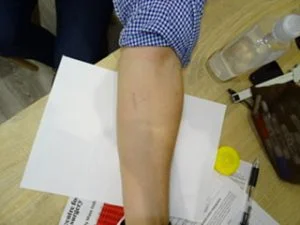 lipoma removal arm after