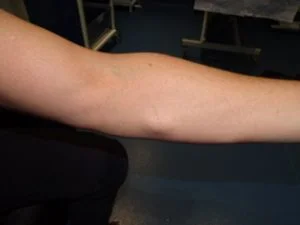 lipoma removal arm before