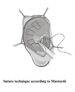 otoplasty incisions