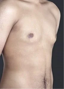 bodytite male breast reduction before