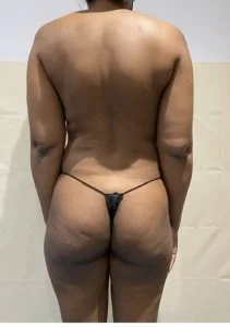 brazilian butt lift before london