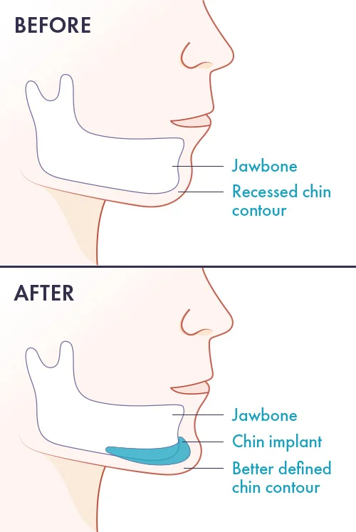 chin augmentation with chin implants diagram