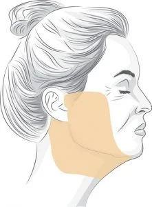 facelift explainer diagram