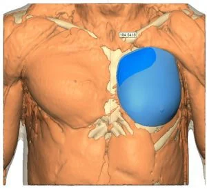 poland syndrome custom implant