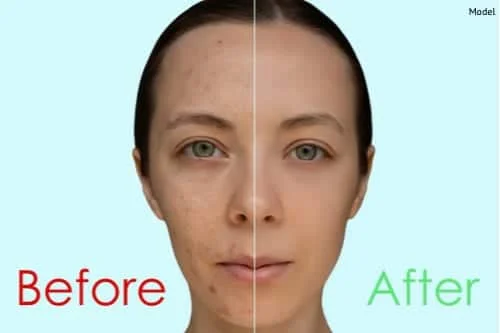 chemical peels acne scarring