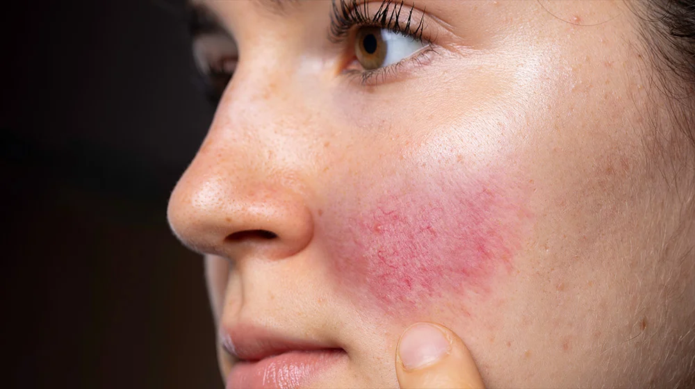 rosacea london