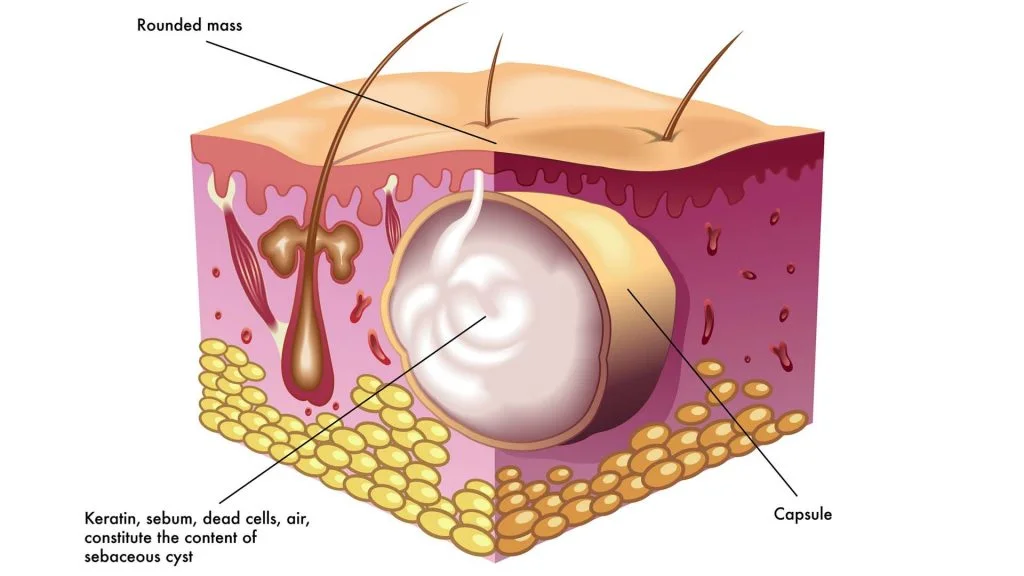 cyst removal diagram