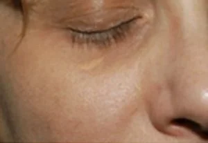 xanthelasma removal lower eyelid before