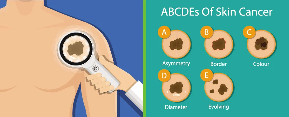 ABCDE of skin cancer