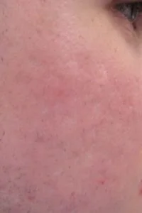 laser acne scar removal after