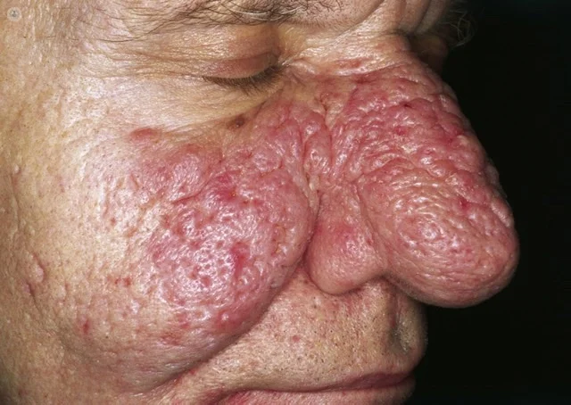 rhinophyma of nose