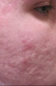 laser acne scar removal before