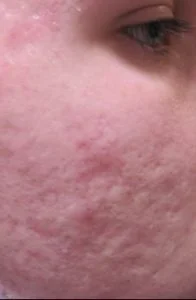 laser acne scar removal before