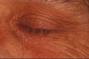 xanthelasma removal inner eye after