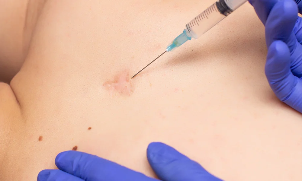 Steroid injection for scar revision