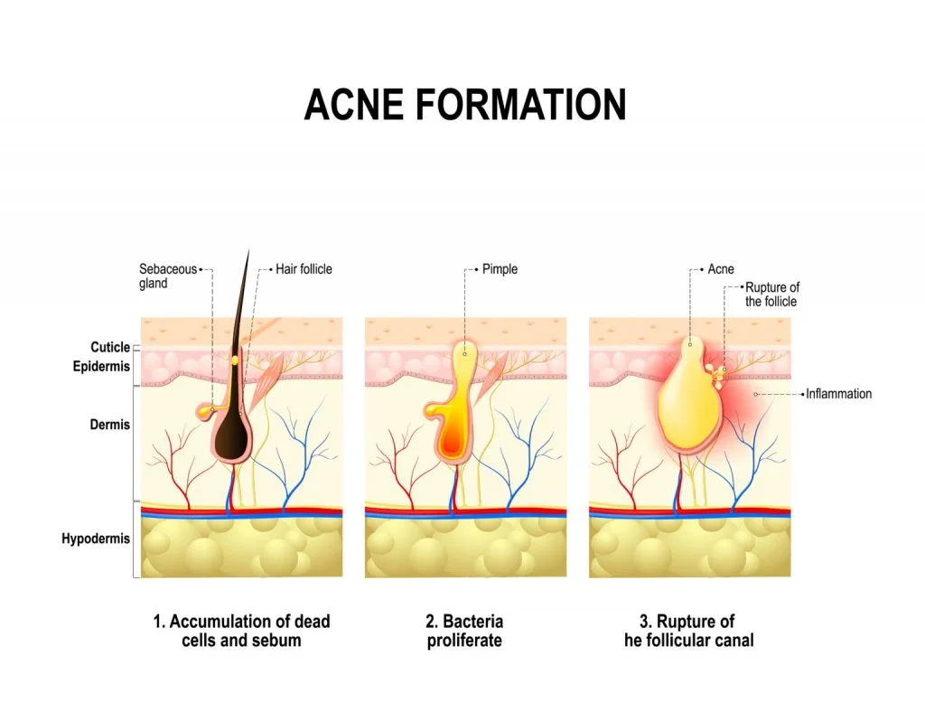 acne-formation-diagram-1024x777.jpg.webp