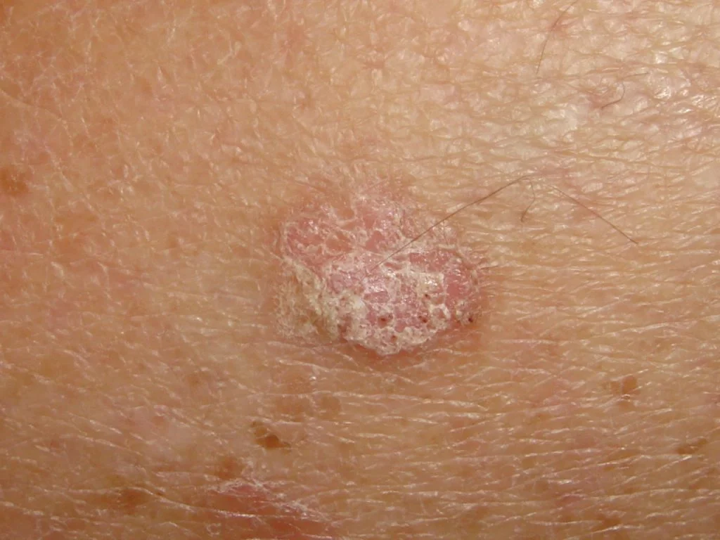 actinic-keratosis-london-1024x768.jpg.webp?format=webp&nv=212368fc-2000-40d1-9026-c0f94abda644