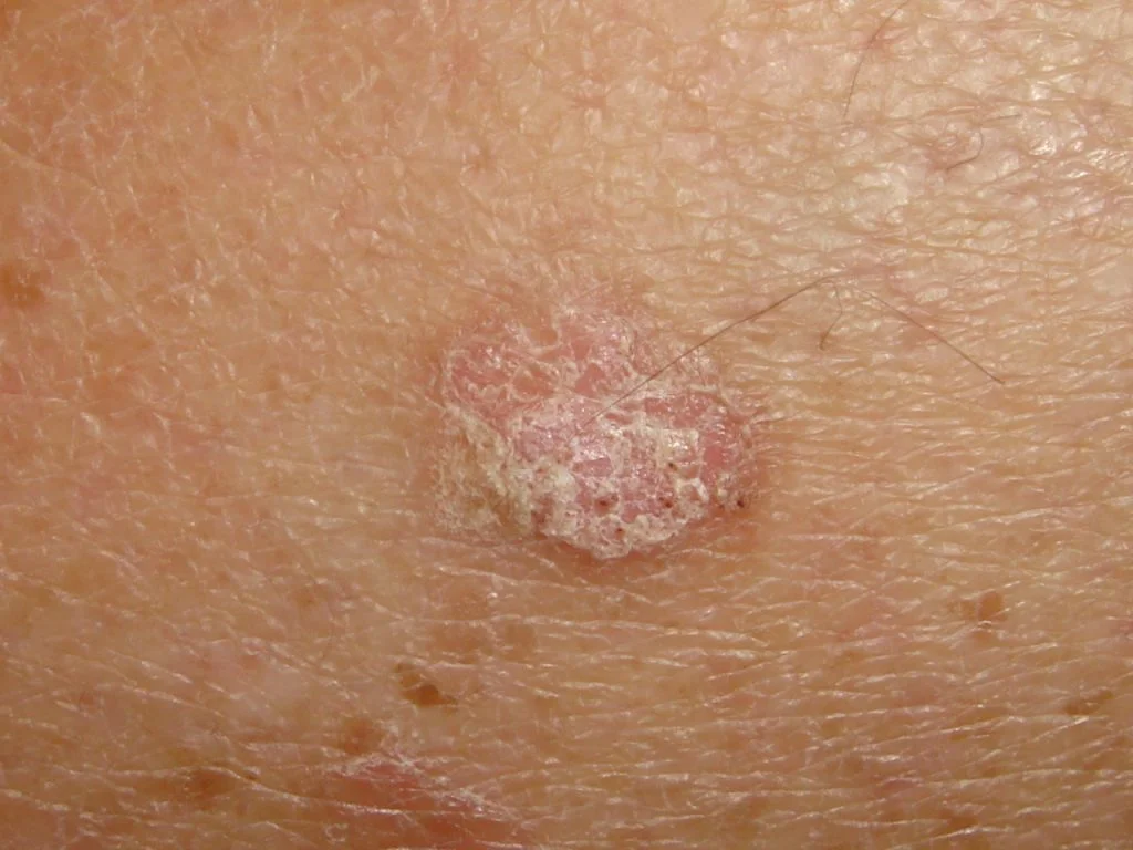 actinic keratosis treatment london