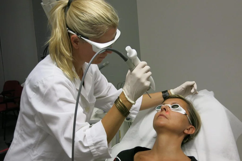 rosacea laser acne treatment