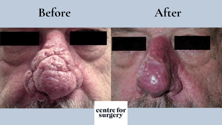rhinophyma treatment before after 1