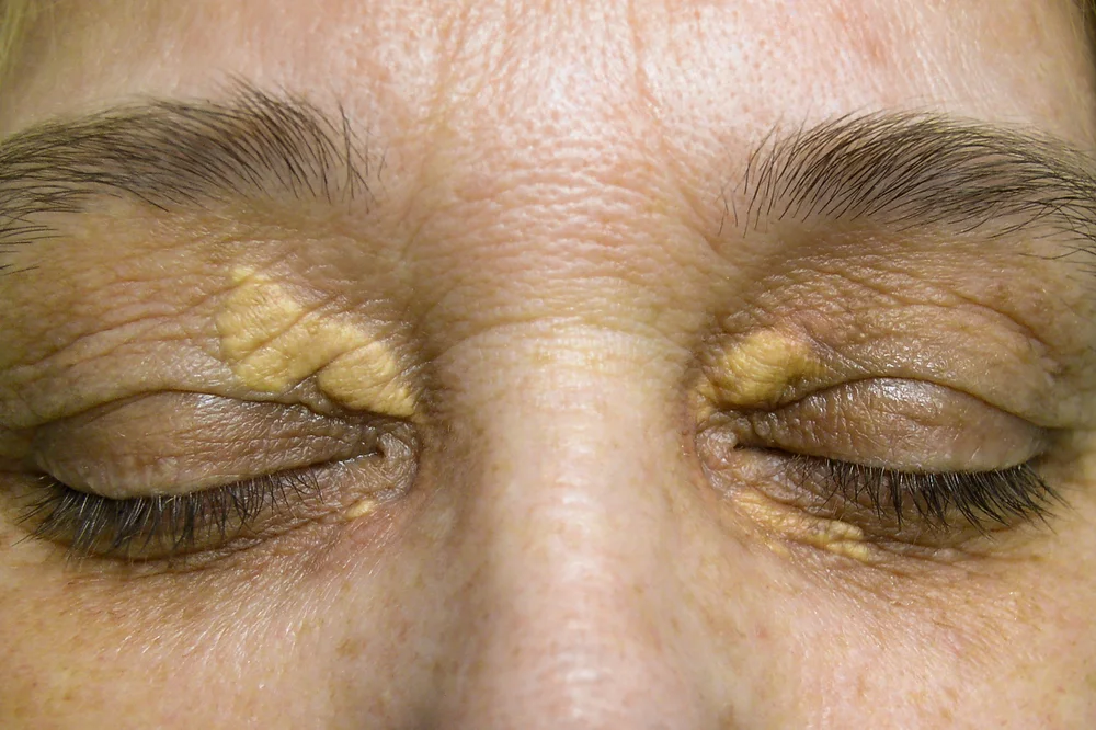 xanthelasma removal london