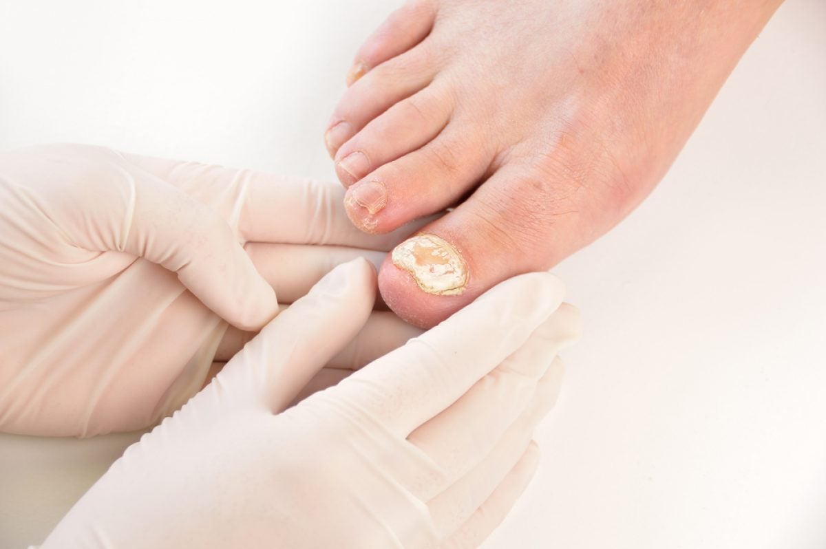 Nail Repair Essence Reviews: Are Anti-Fungal Nail Solutions Safe For Use?