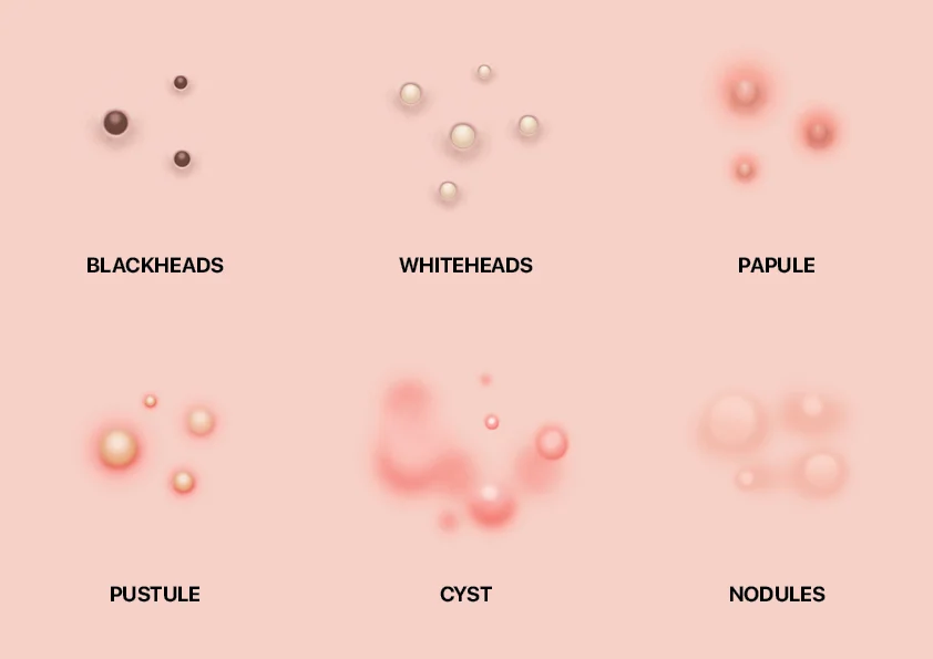 types of acne spots
