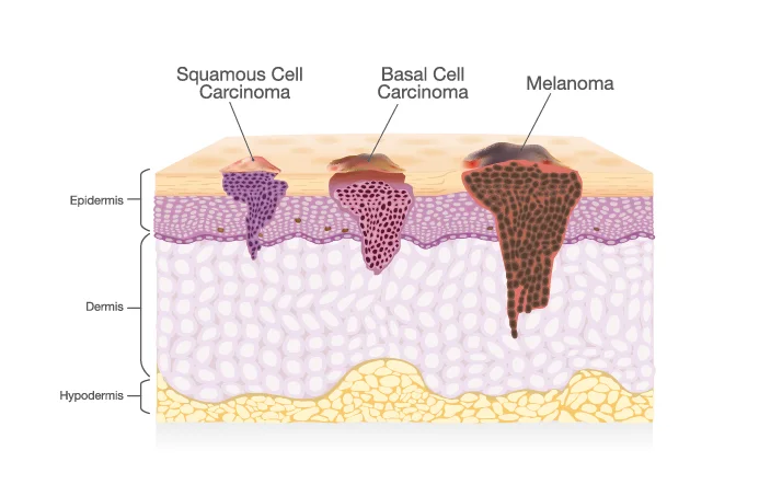 types of skin cancer