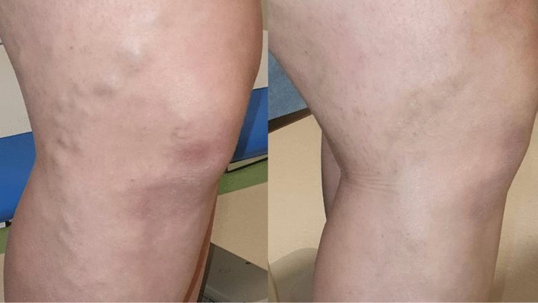 varicose veins removal before after