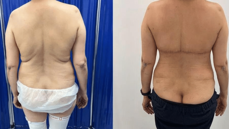 What procedure removes back fat folds, extra skin, bra strap fat