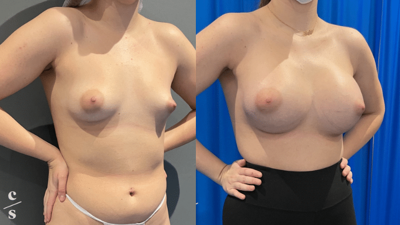 tuberous breast correction before after 1