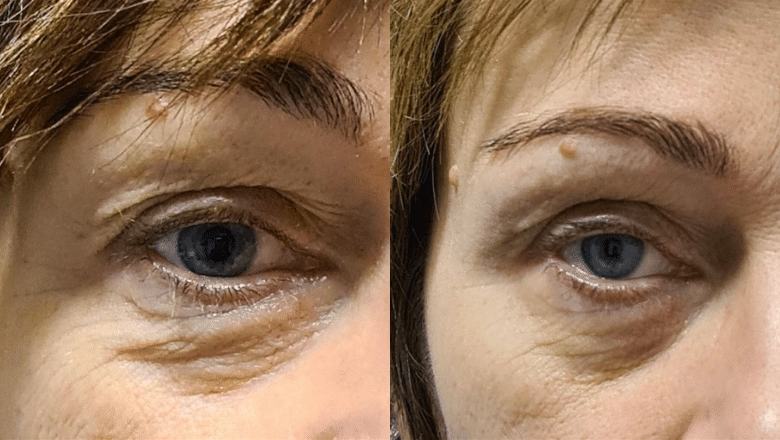 smootheye non surgical eye lift before after