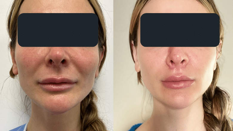 lip lift before after frontal view