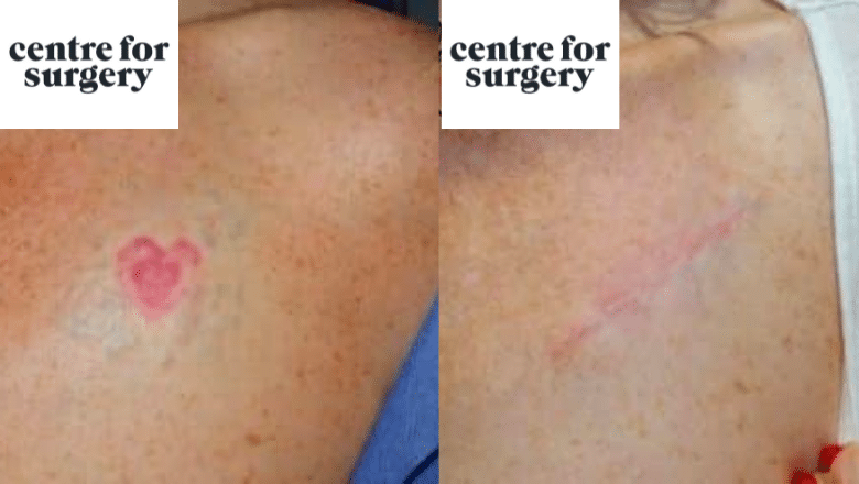 Man returns for second laser treatment to remove tattoo