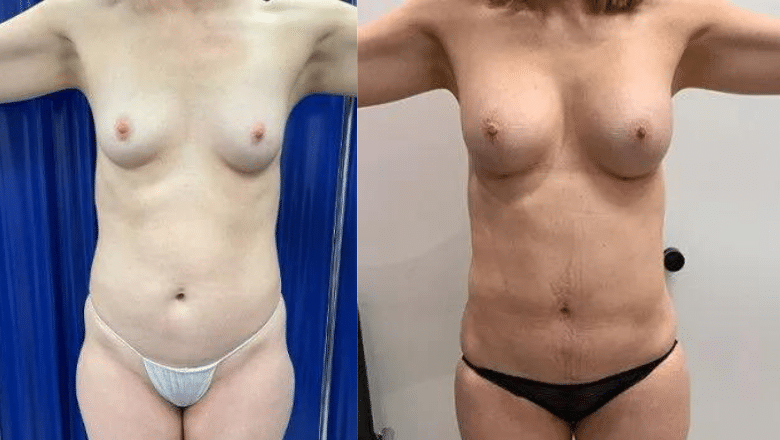fat transfer breasts before after 1