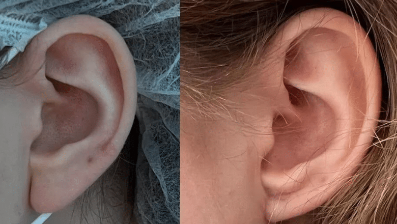 earlobe reduction surgery before after 3