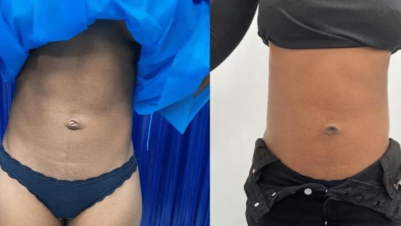 umbilicoplasty before and after