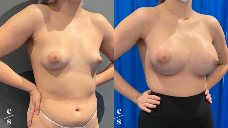 breast asymmetry correction before after 1