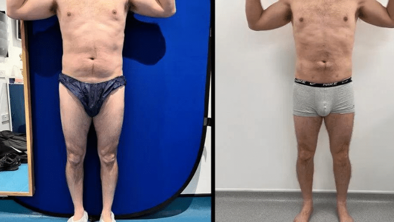 male calf implant results before after 1