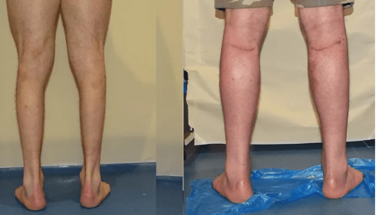 calf augmentation implants before after 4