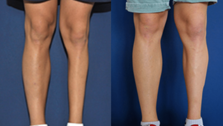 3d custom designed calf implant results