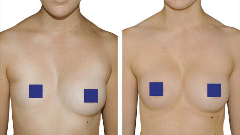 Breast Asymmetry Surgery