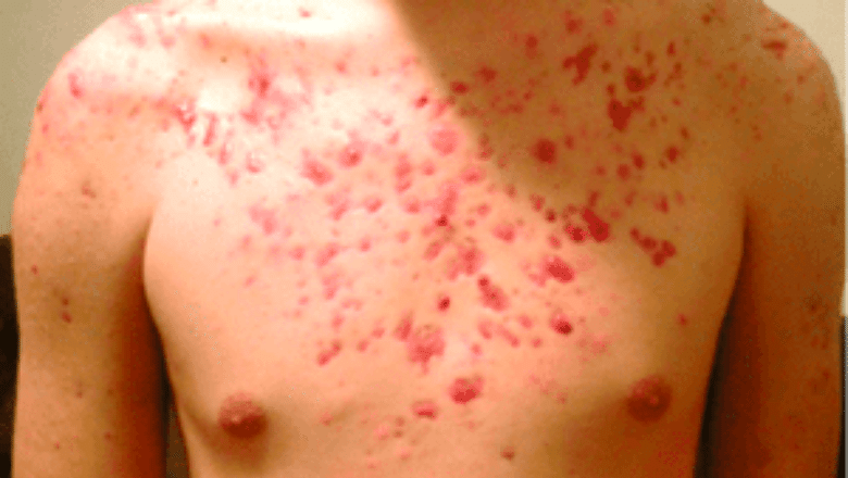 chest acne laser treatment before