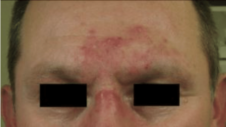 rosacea forehead