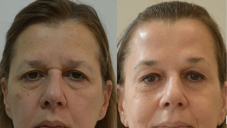 lower blepharoplasty & brow lift before after