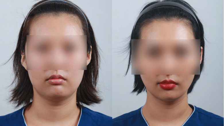 chin lipo before and after