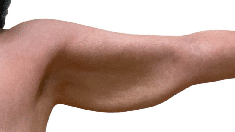 full arm lift before