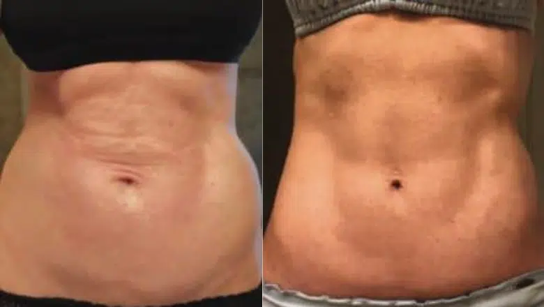 bodytite and Morpheus8 abdomen before after 2